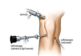 Arthroscopic Surgery